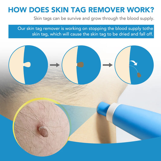 Auto Skin Tag Removal Kit For Small to Large Skin Tags 2-8mm With Cleansing Swabs and 2 Size Bands Easy To Use Skin Care Tool